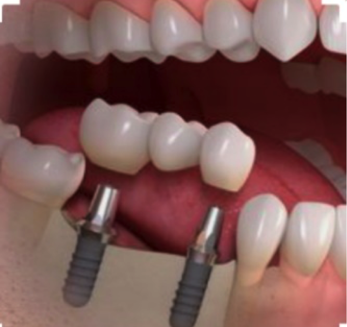 Dental Implants Near Me