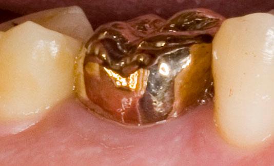 When Do You Need a Tooth Crown?