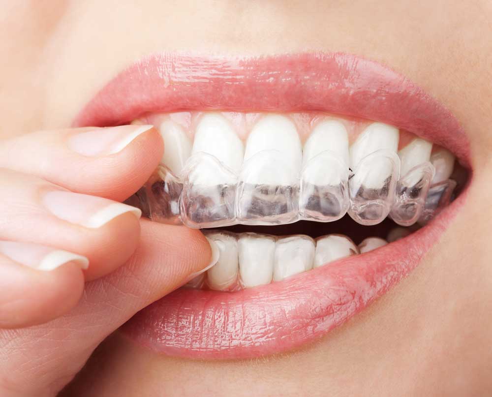 Invisalign Near Me